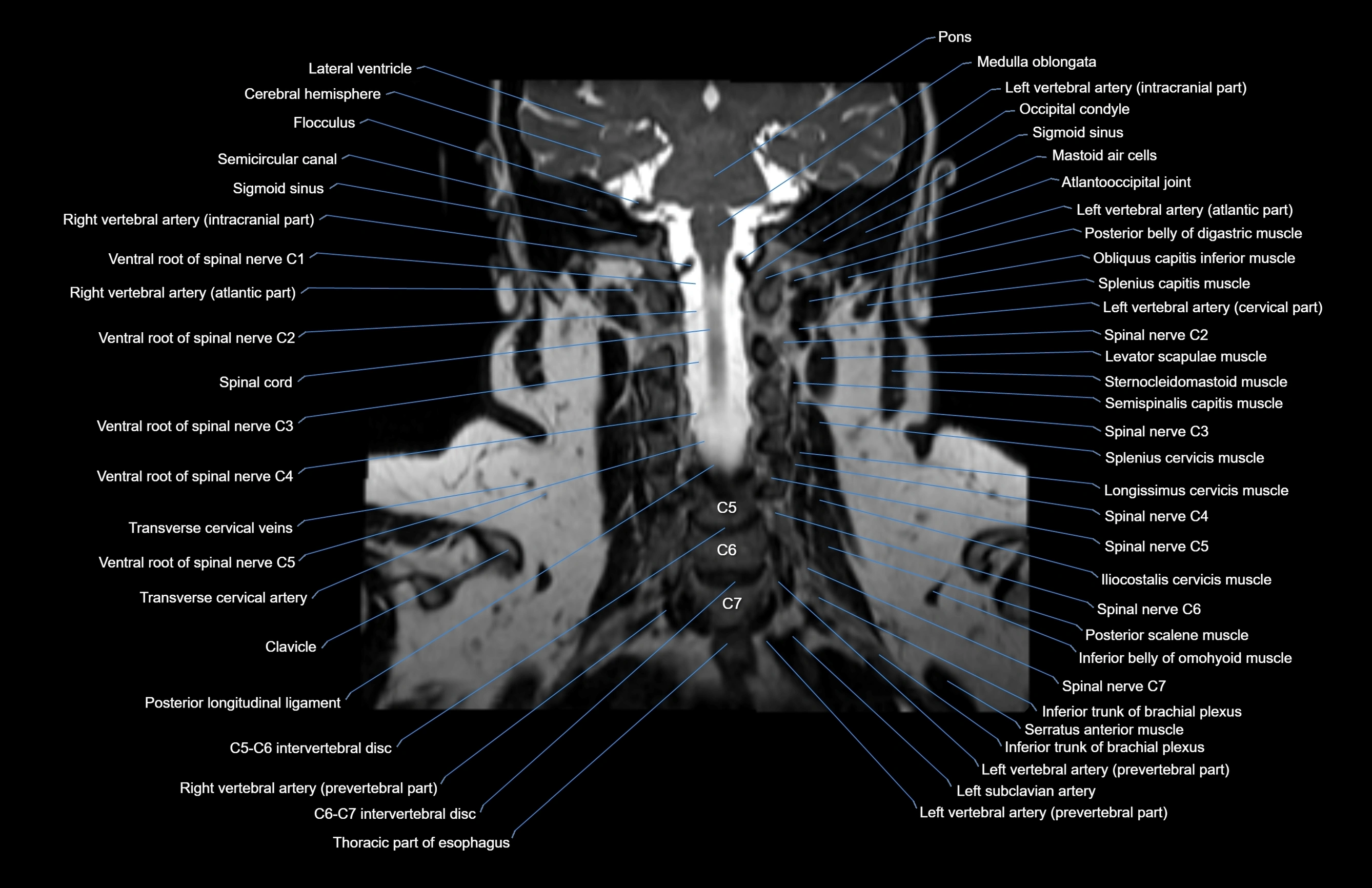 Neck coronal cross sectional MRI anatomy 3T MRI  image-img-00001-00026.webp